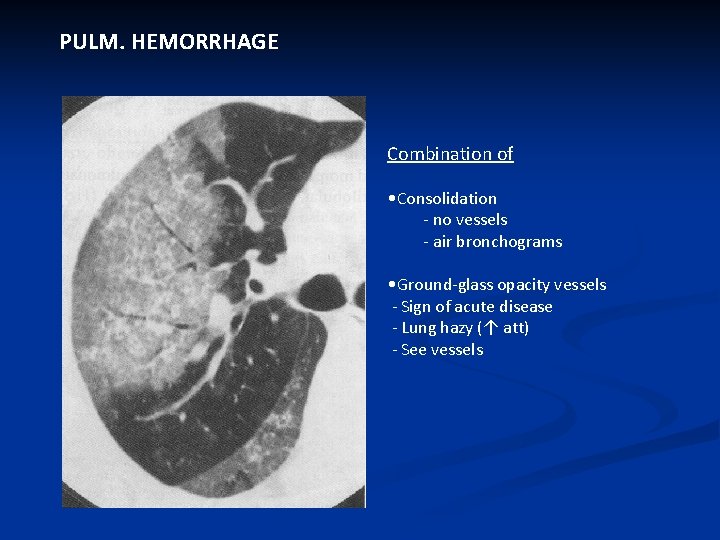 PULM. HEMORRHAGE Combination of • Consolidation - no vessels - air bronchograms • Ground-glass