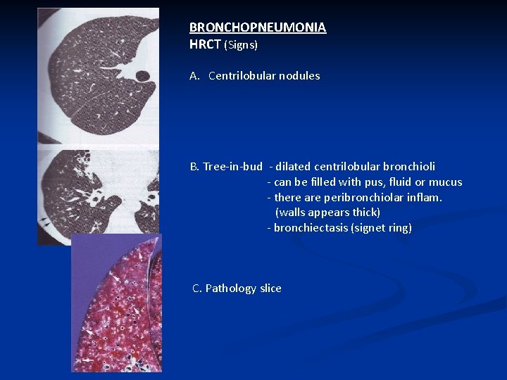 BRONCHOPNEUMONIA HRCT (Signs) A. Centrilobular nodules B. Tree-in-bud - dilated centrilobular bronchioli - can