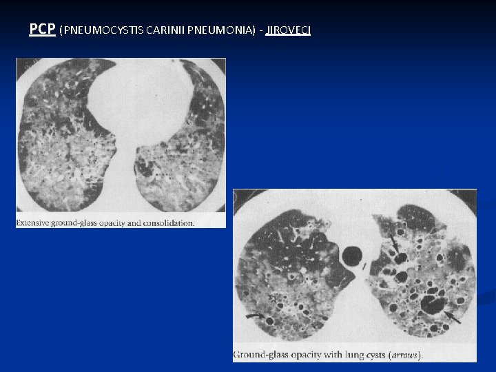 PCP (PNEUMOCYSTIS CARINII PNEUMONIA) - JIROVECI 