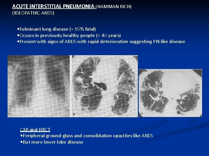 ACUTE INTERSTITIAL PNEUMONIA (HAMMAN RICH) (IDEOPATHIC ARDS) • Fulminant lung disease (> 50% fatal)