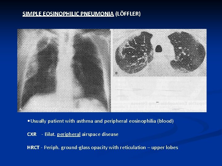 SIMPLE EOSINOPHILIC PNEUMONIA (LÖFFLER) • Usually patient with asthma and peripheral eosinophilia (blood) CXR