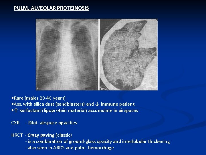 PULM. ALVEOLAR PROTEINOSIS • Rare (males 20 -40 years) • Ass. with silica dust