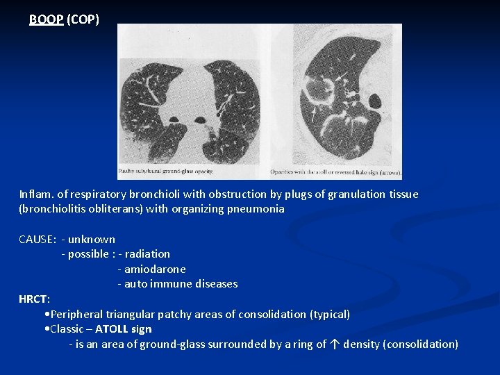 BOOP (COP) Inflam. of respiratory bronchioli with obstruction by plugs of granulation tissue (bronchiolitis