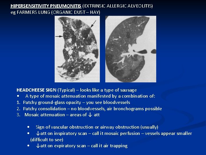 HIPERSENSITIVITY PNEUMONITIS (EXTRINSIC ALLERGIC ALVEOLITIS) eg FARMERS LUNG (ORGANIC DUST – HAY) HEADCHEESE SIGN