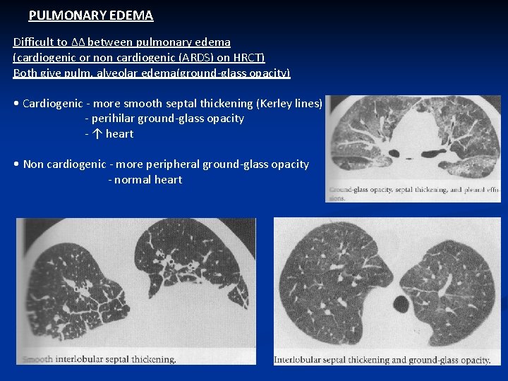 PULMONARY EDEMA Difficult to ΔΔ between pulmonary edema (cardiogenic or non cardiogenic (ARDS) on