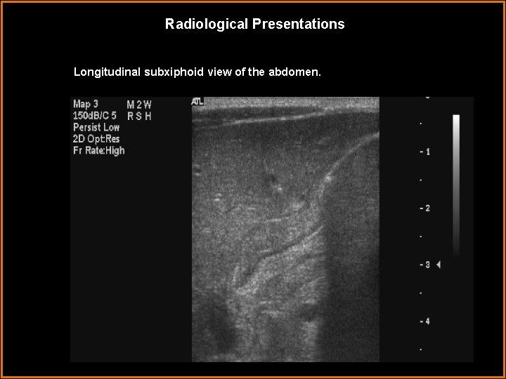 Radiological Presentations Longitudinal subxiphoid view of the abdomen. 