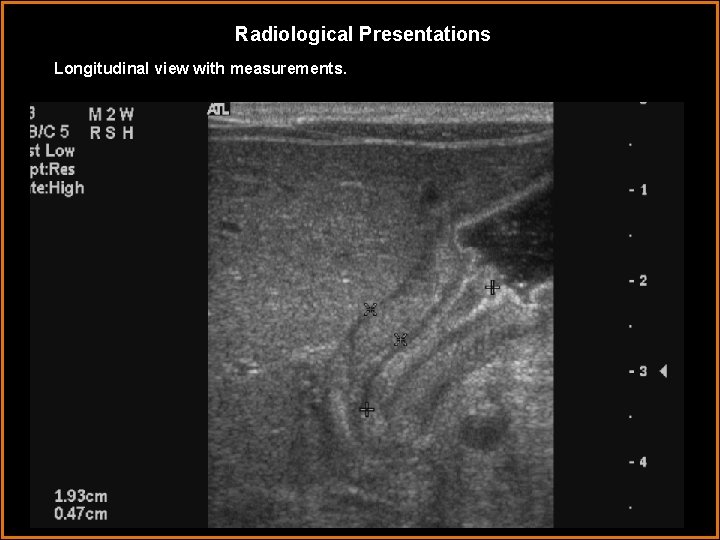 Radiological Presentations Longitudinal view with measurements. 