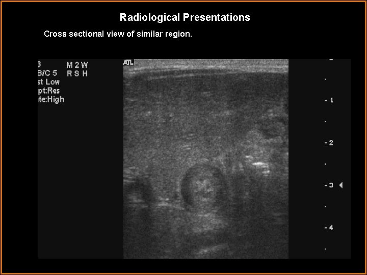 Radiological Presentations Cross sectional view of similar region. 