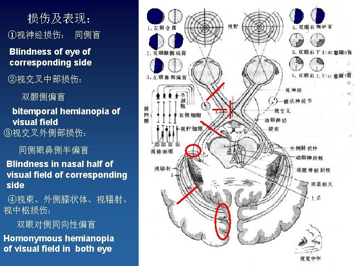 损伤及表现： ①视神经损伤： 同侧盲 Blindness of eye of corresponding side ②视交叉中部损伤： 双颞侧偏盲 bitemporal hemianopia of