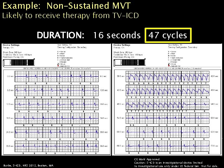 Example: Non-Sustained MVT Likely to receive therapy from TV-ICD CRM-88604 -AA JUN 2012 DURATION: