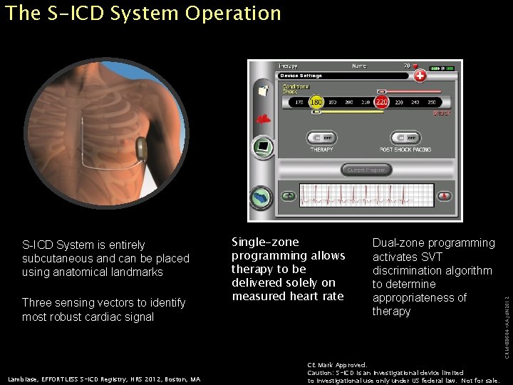 S-ICD System is entirely subcutaneous and can be placed using anatomical landmarks Three sensing