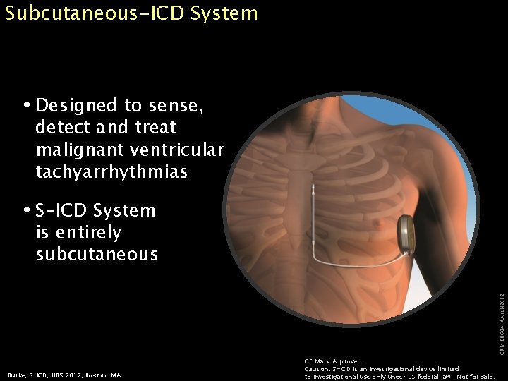 Subcutaneous-ICD System Designed to sense, detect and treat malignant ventricular tachyarrhythmias CRM-88604 -AA JUN