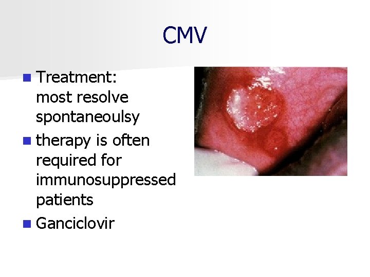 CMV n Treatment: most resolve spontaneoulsy n therapy is often required for immunosuppressed patients