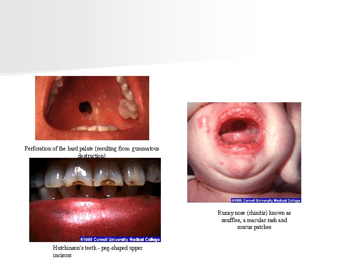 Perforation of the hard palate (resulting from gummatous destruction) Runny nose (rhinitis) known as