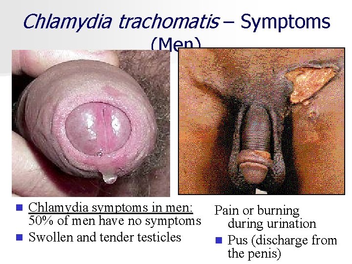 Chlamydia trachomatis – Symptoms (Men) Chlamydia symptoms in men: 50% of men have no