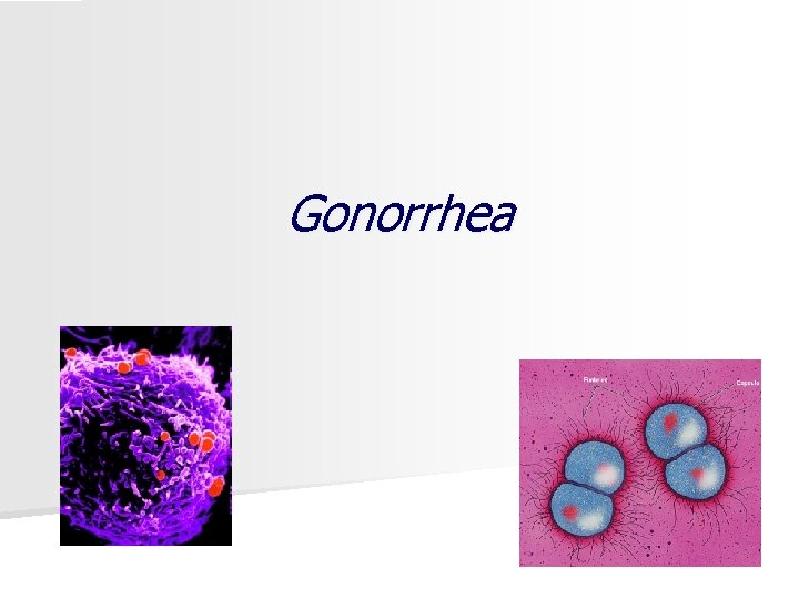 Gonorrhea 