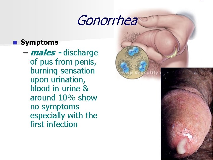 Gonorrhea n Symptoms: – males - discharge of pus from penis, burning sensation upon