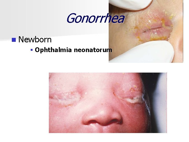 Gonorrhea n Newborn § Ophthalmia neonatorum 