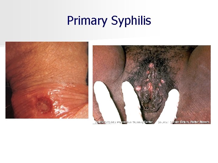 Primary Syphilis 
