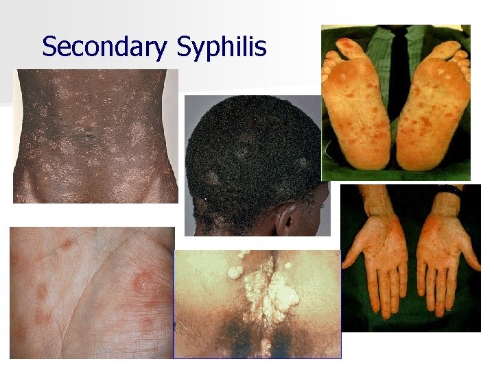 Secondary Syphilis 