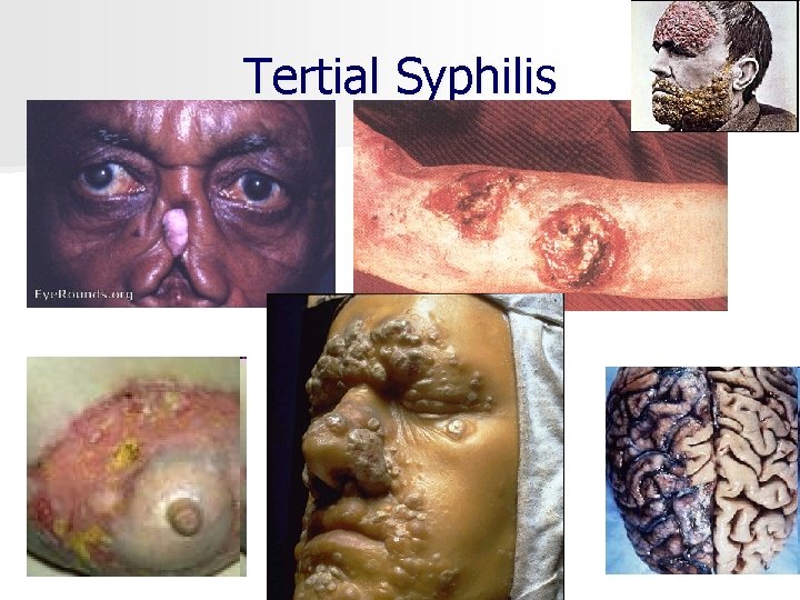 Tertial Syphilis 
