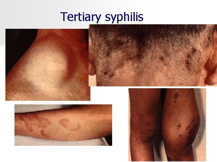 Tertiary syphilis 