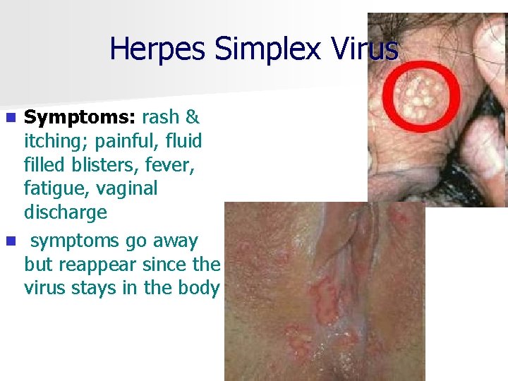 Herpes Simplex Virus Symptoms: rash & itching; painful, fluid filled blisters, fever, fatigue, vaginal
