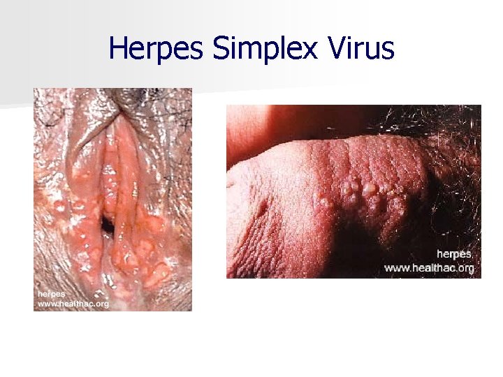 Herpes Simplex Virus 