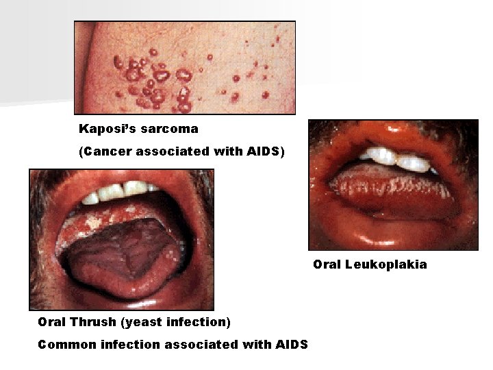 Kaposi’s sarcoma (Cancer associated with AIDS) Oral Leukoplakia Oral Thrush (yeast infection) Common infection