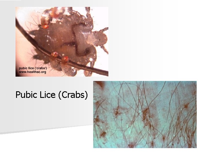 Pubic Lice (Crabs) 