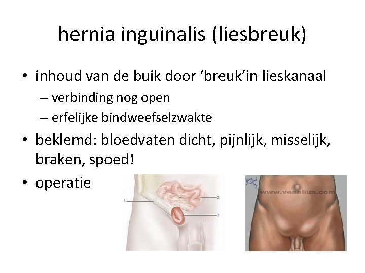 hernia inguinalis (liesbreuk) • inhoud van de buik door ‘breuk’in lieskanaal – verbinding nog