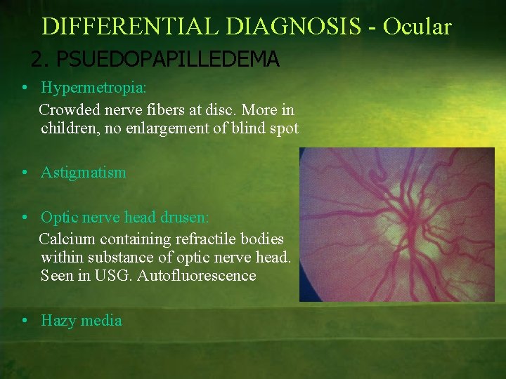 DIFFERENTIAL DIAGNOSIS - Ocular 2. PSUEDOPAPILLEDEMA • Hypermetropia: Crowded nerve fibers at disc. More