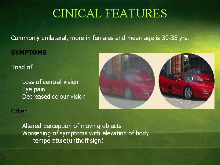 CINICAL FEATURES Commonly unilateral, more in females and mean age is 30 -35 yrs.