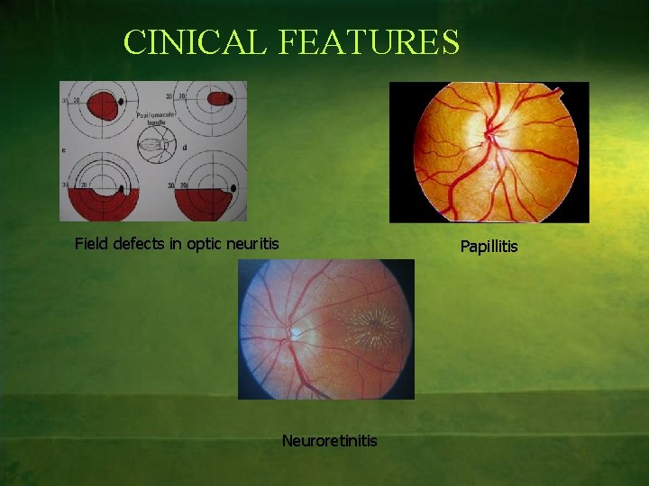 CINICAL FEATURES Field defects in optic neuritis Papillitis Neuroretinitis 