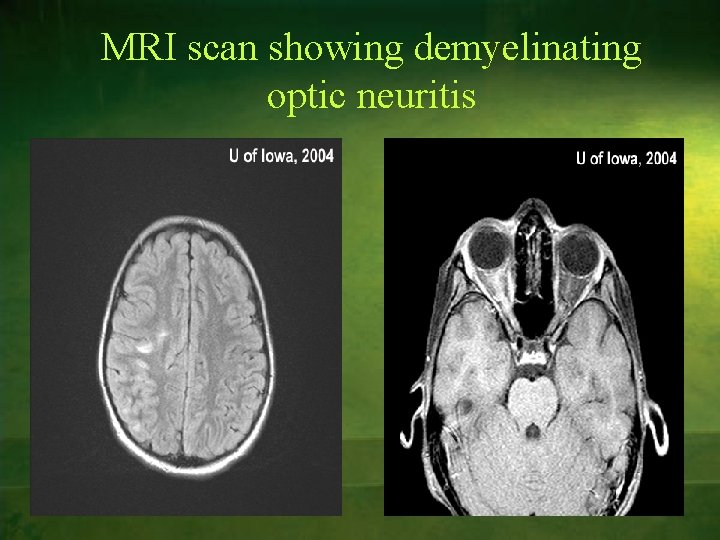 MRI scan showing demyelinating optic neuritis 