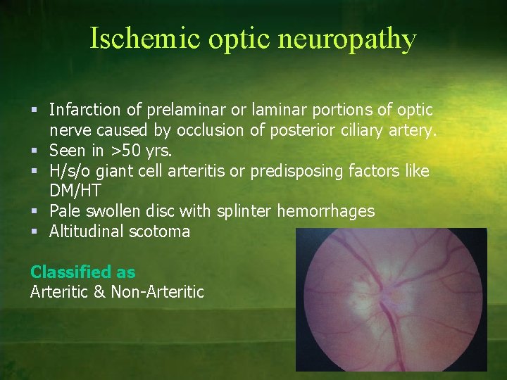 Ischemic optic neuropathy § Infarction of prelaminar or laminar portions of optic nerve caused