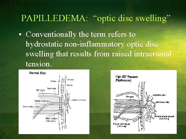 PAPILLEDEMA: “optic disc swelling” • Conventionally the term refers to hydrostatic non-inflammatory optic disc