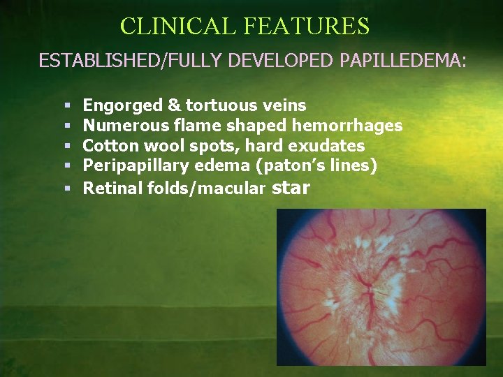 CLINICAL FEATURES ESTABLISHED/FULLY DEVELOPED PAPILLEDEMA: § § § Engorged & tortuous veins Numerous flame