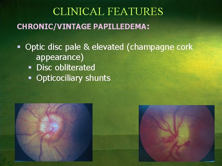 CLINICAL FEATURES CHRONIC/VINTAGE PAPILLEDEMA: § Optic disc pale & elevated (champagne cork appearance) §