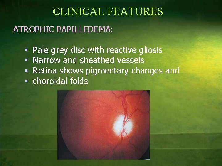 CLINICAL FEATURES ATROPHIC PAPILLEDEMA: § § Pale grey disc with reactive gliosis Narrow and