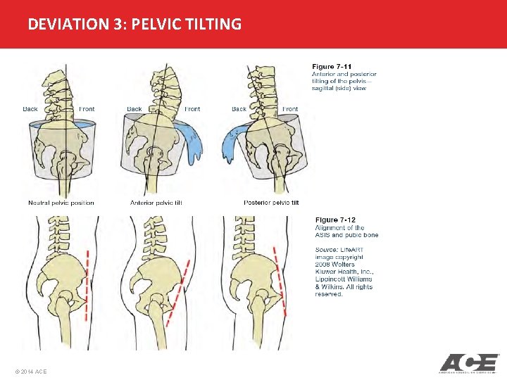 DEVIATION 3: PELVIC TILTING © 2014 ACE 