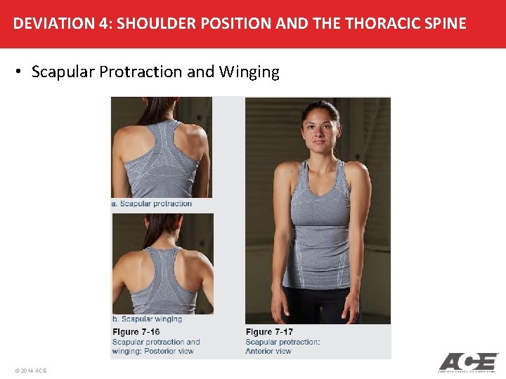 DEVIATION 4: SHOULDER POSITION AND THE THORACIC SPINE • Scapular Protraction and Winging ©