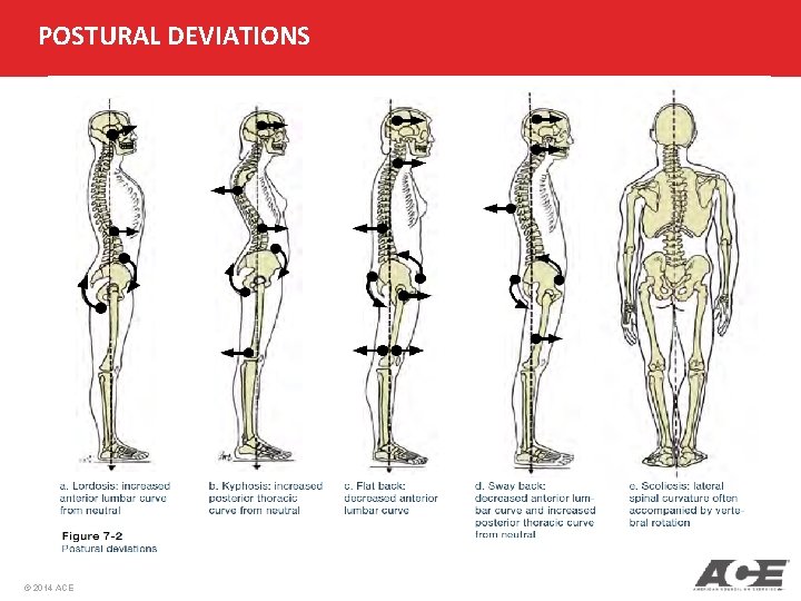 POSTURAL DEVIATIONS © 2014 ACE 