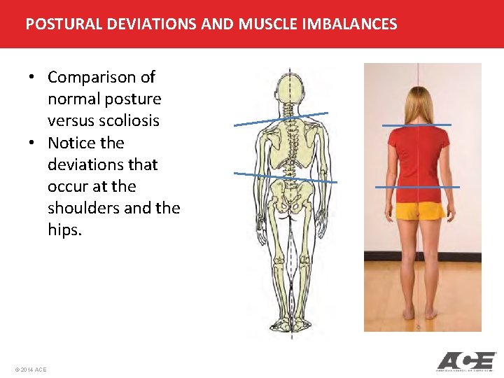 POSTURAL DEVIATIONS AND MUSCLE IMBALANCES • Comparison of normal posture versus scoliosis • Notice