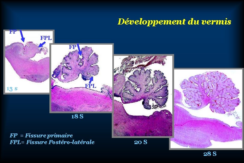 Développement du vermis FP FPL 13 s 18 S FP = Fissure primaire FPL=