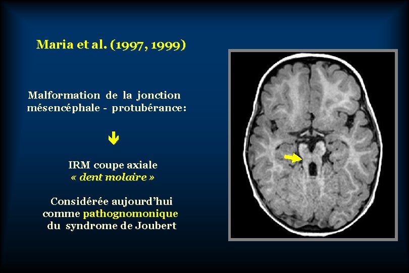 Maria et al. (1997, 1999) Malformation de la jonction mésencéphale - protubérance: IRM coupe