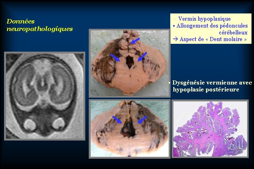 Données neuropathologiques • Vermis hypoplasique • Allongement des pédoncules cérébelleux Aspect de « Dent