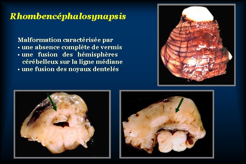Rhombencéphalosynapsis Malformation caractérisée par • une absence complète de vermis • une fusion des
