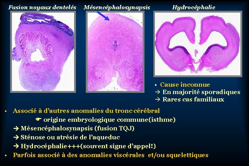 Fusion noyaux dentelés Mésencéphalosynapsis Hydrocéphalie • Cause inconnue En majorité sporadiques Rares cas familiaux