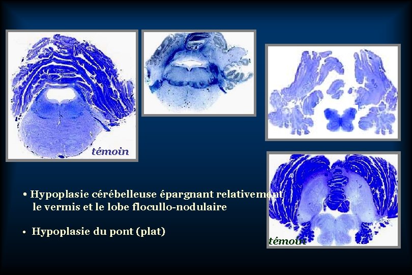 témoin • Hypoplasie cérébelleuse épargnant relativement le vermis et le lobe flocullo-nodulaire • Hypoplasie